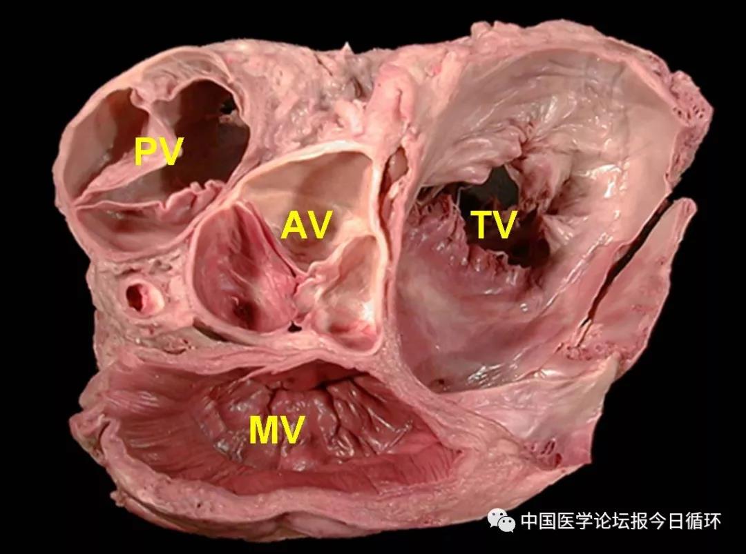 主动脉弓及其毗邻结构的解剖实物图(raa:右心耳;arch主动脉弓;lpa左肺