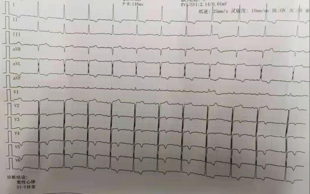 图1  窦性心律,st压低
