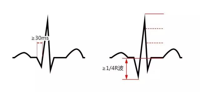 急性心梗心电图,各阶段特点汇总分析