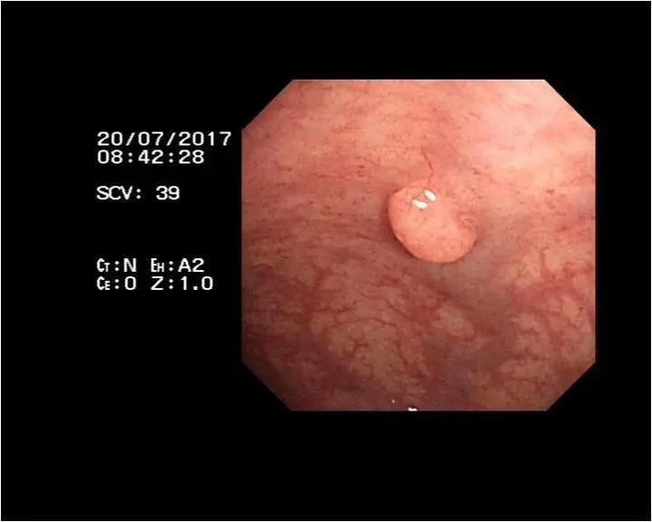 5 mm直肠息肉的20年成癌记