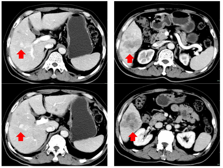 影像学检查:2018-10-23,肝脏ct增强检查:右肝占位(直径约8cm),肝癌伴