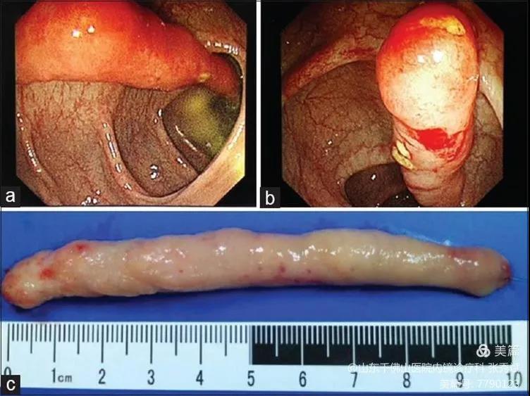图解真相 | 结肠黏膜-黏膜下细长息肉