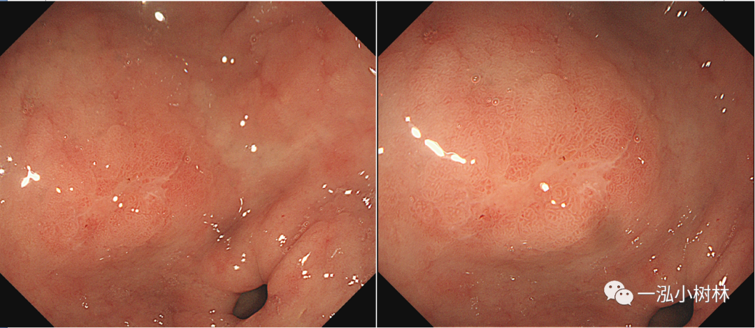 内镜下正常胃十二指肠黏膜结构(附2例早癌病例)