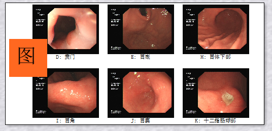 教你快速读懂胃镜报告