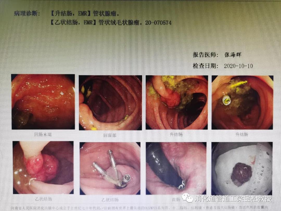 让人无比纠结的肠息肉切除术后出血