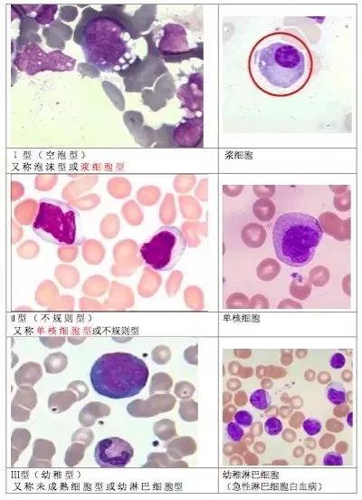 一文读懂异型淋巴细胞 | 今日技能