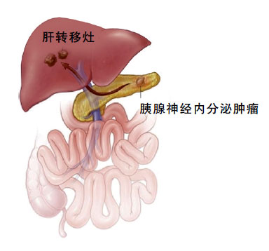 胰腺神经内分泌肿瘤的外科治疗