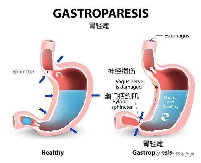 餐后4小时胃潴留>10%和/ 在胃轻瘫的诊断上,目前临床还是更强调胃轻瘫