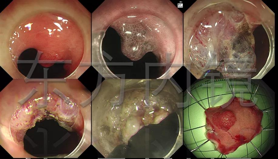 一文读懂食管胃结合部息肉样隆起的内镜治疗