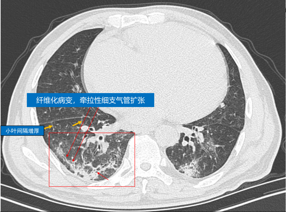 【一手资料】3例新型冠状病毒肺炎影像学表现来了!