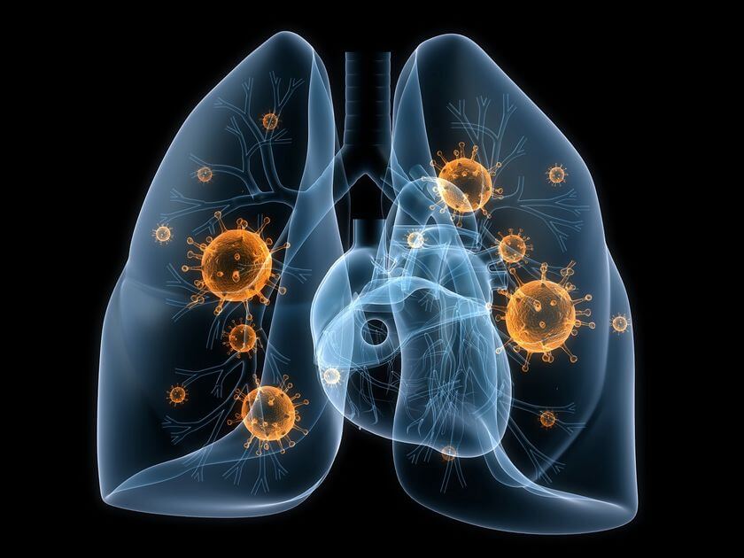 bacterial-lung-infection-symptoms-fungal-bacterial-viral-mybodypain.com-01.jpg