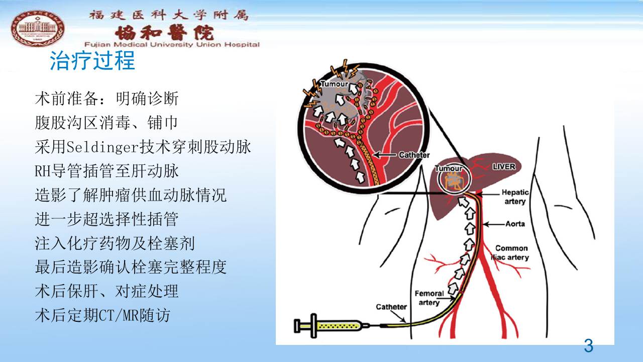 福医美国校友会(aafmua)大查房 肝癌的tace治疗和晚期肝癌的治疗进展
