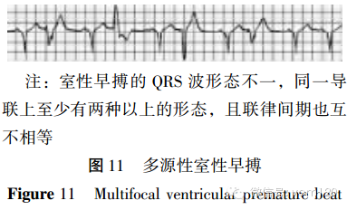 6,心室率>180次/min 的心动过速 多源性室性早搏 由两个或两个以上