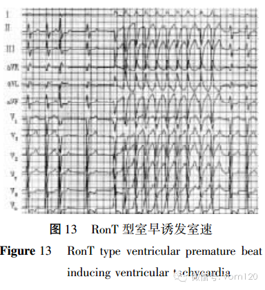 6,心室率>180次/min 的心动过速 lown等将ront现象的室性早搏列为最高