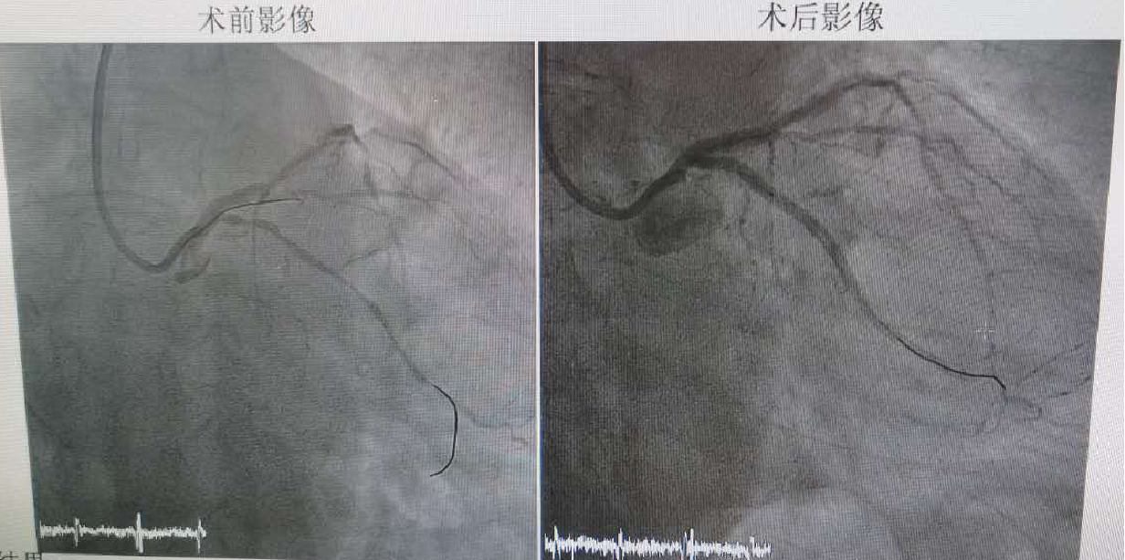 三支病变血管通病例