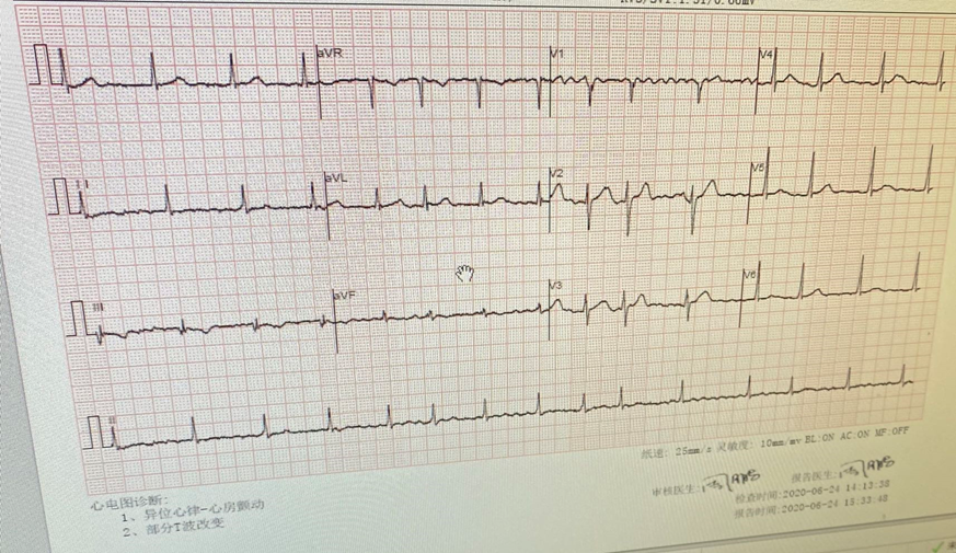 心电图诊断报告1,异位心律—心房颤动     2,部分t波改变冠脉造影:术