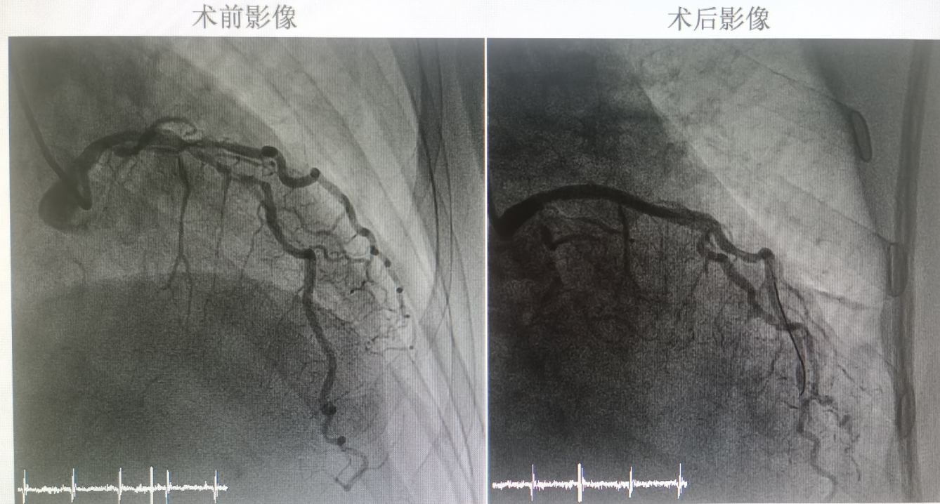 弥漫性病变 急性冠脉综合征 冠状动脉粥样硬化性心脏病 心房颤动 2型