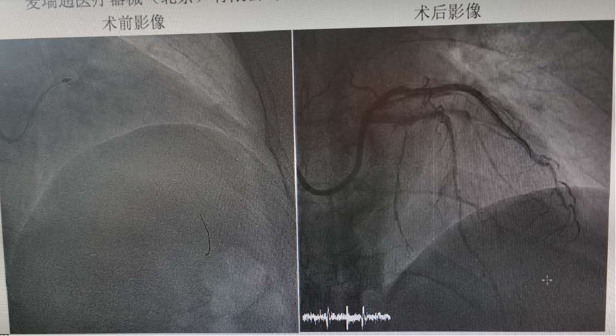 三支病变血管通病例