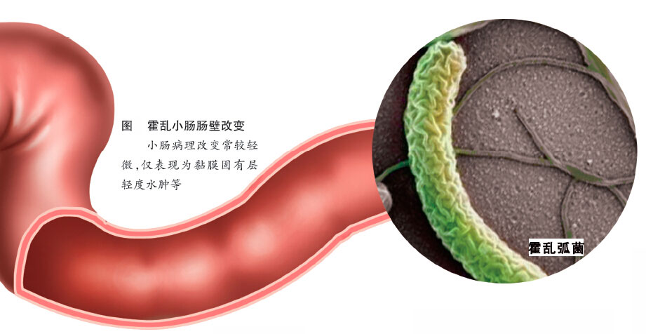 中毒型病例(干性霍乱) 起病很急,患者常在尚未出现泻吐症状时即