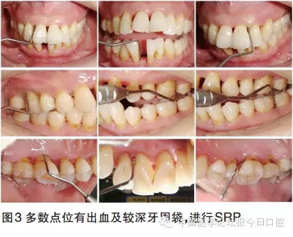 【临床实例】牙周病正畸