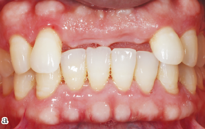 【临床实例】上牙列缺损伴慢性牙周炎牙齿移位一例