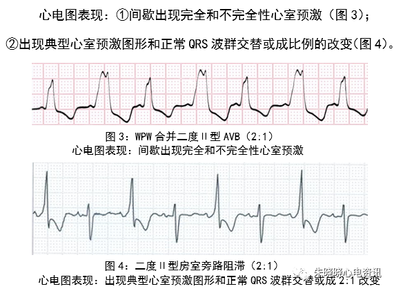 预激综合征心电图少见表现与诊断思路