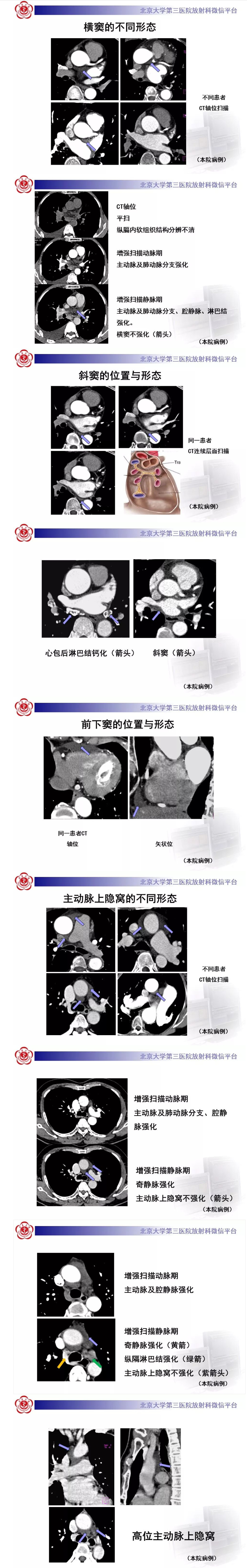 壹生资讯-心包窦及心包隐窝的解剖结构(内附ct断层图解,值得一看!