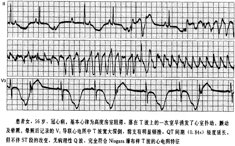 临床必备:猝死预警心电图精准解析(内附经典病例)!