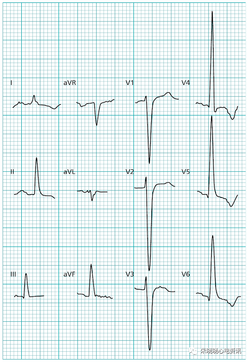 一文读懂常见心肌病的心电图表现