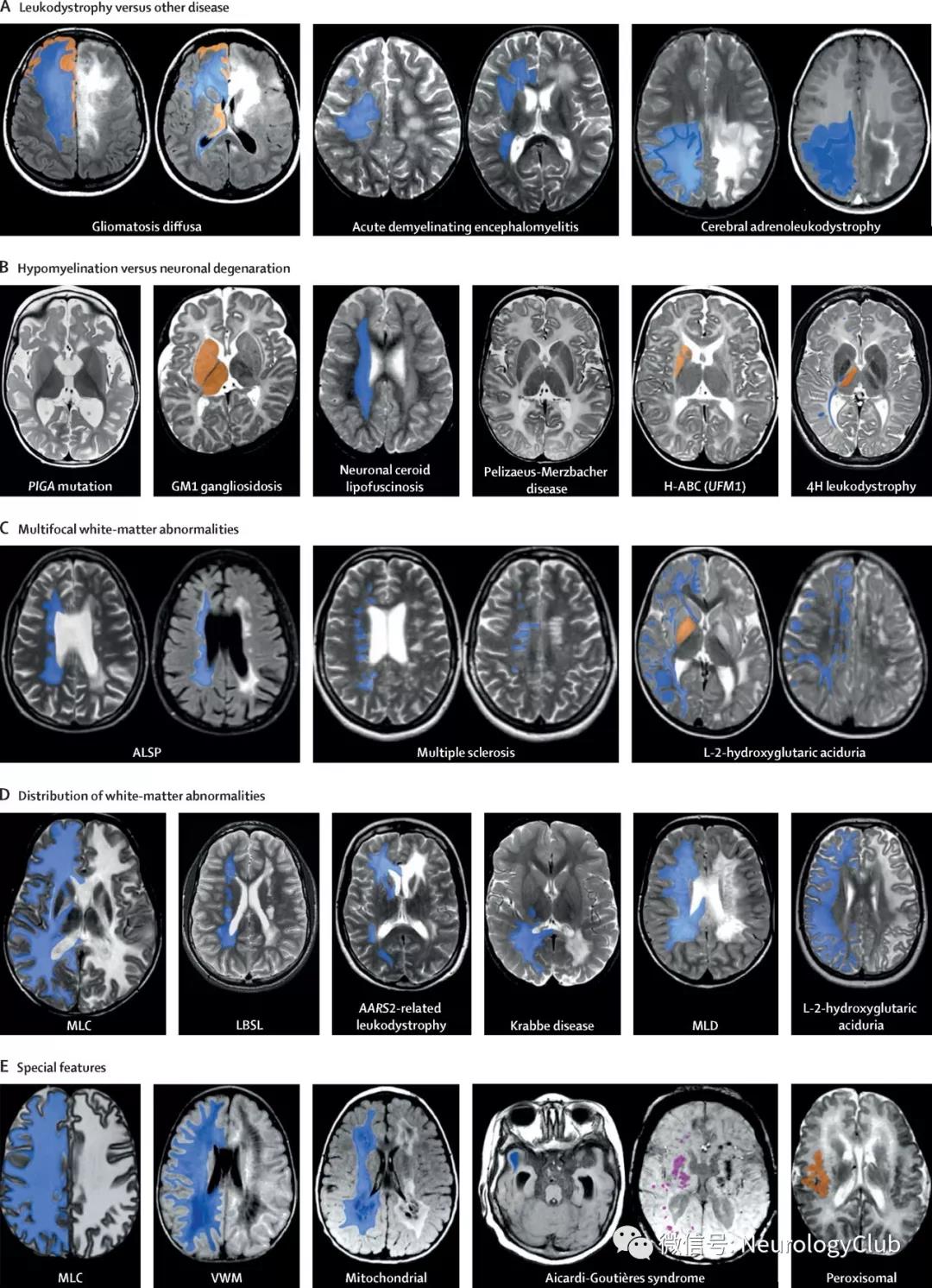 脑白质营养不良的mri诊断策略