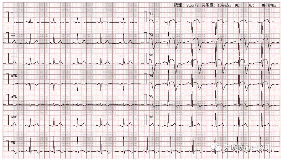 心电图读图解析:急性前壁,前间壁心肌梗死一例