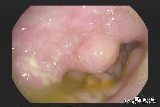 贲门距切牙 40cm,开闭好,齿状线清晰.