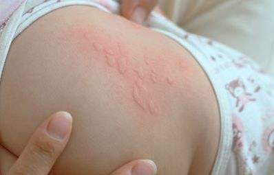 儿童得了过敏性荨麻疹,该如何用药?