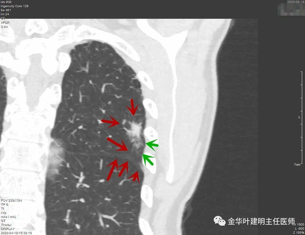 此层面为典型的恶性特征:边缘浸润性生长,结节密度不均,血管征,瘤肺