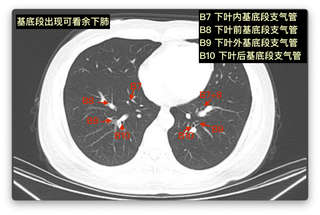 "庖丁解肺":胸ct分叶肺段超全总结