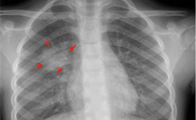 儿童肺炎时胸片怎么看呢