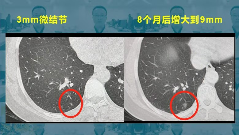 磨玻璃肺结节随访观察,会不会变成肺癌?一次汇总随访的4种结局