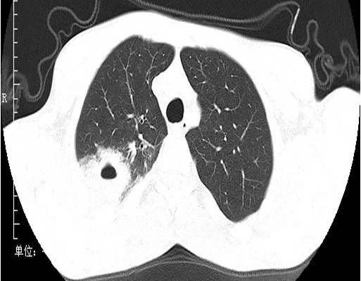 支原体肺炎的 ct 表现: 病例 2:病变进展速度较快,形成多发肺气囊或