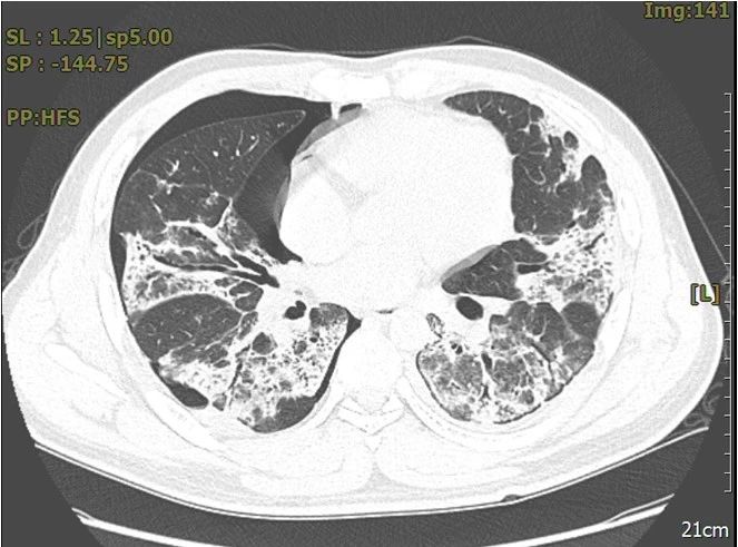 支原体肺炎的 ct 表现: 病例 2:病变进展速度较快,形成多发肺气囊或