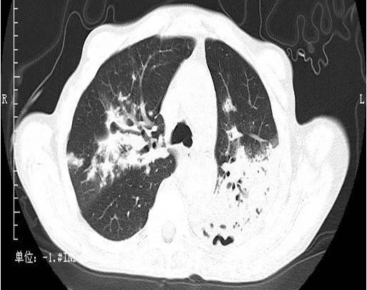 鉴别诊断:干酪性肺炎大叶性肺炎01