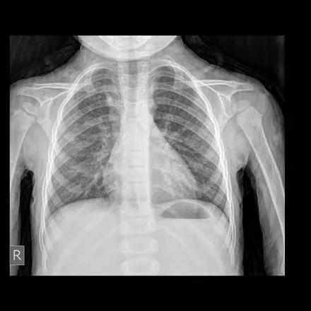 儿童肺炎时,胸片怎么看呢?