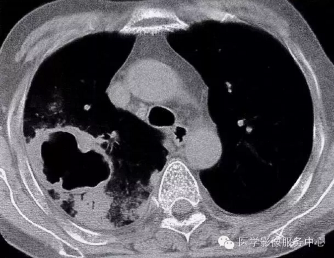 收藏!肺部炎症的"七大"常见ct表现