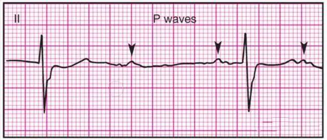 汇总帖丨14种常见心电图波形的特点