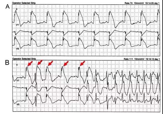 临床必备:猝死预警心电图分析(经典病例)