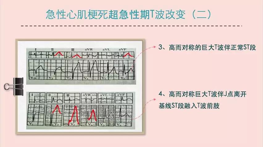 心电图各导联在心脏上的定位 急性心肌梗死心电图表现