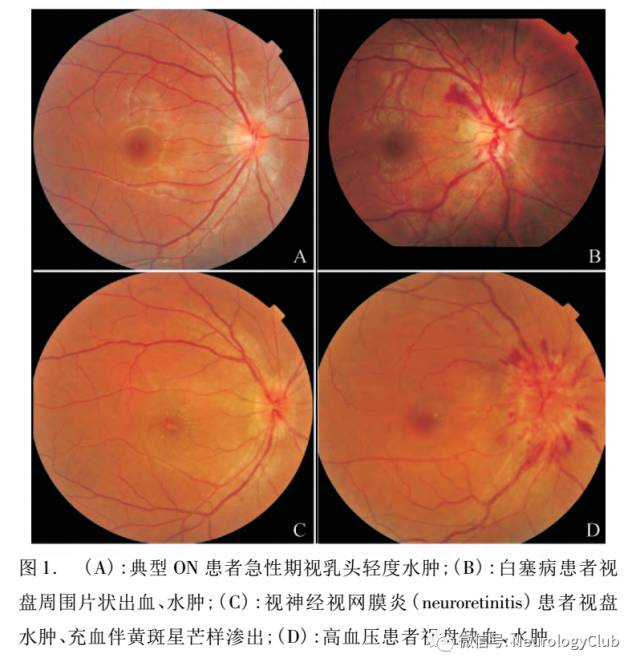 视神经炎的分类及诊疗进展
