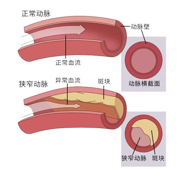 关于颈动脉斑块,这些知识必须掌握