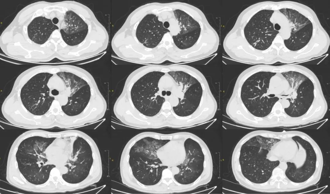 左肺支气管扩张(图1),诊断咯血,支气管扩张,给予药物止血及