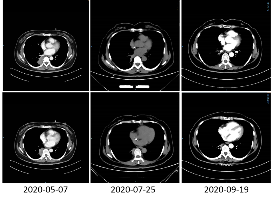 胸腹影像学改变.png