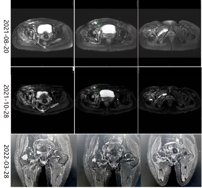 骨盆mri改变.png